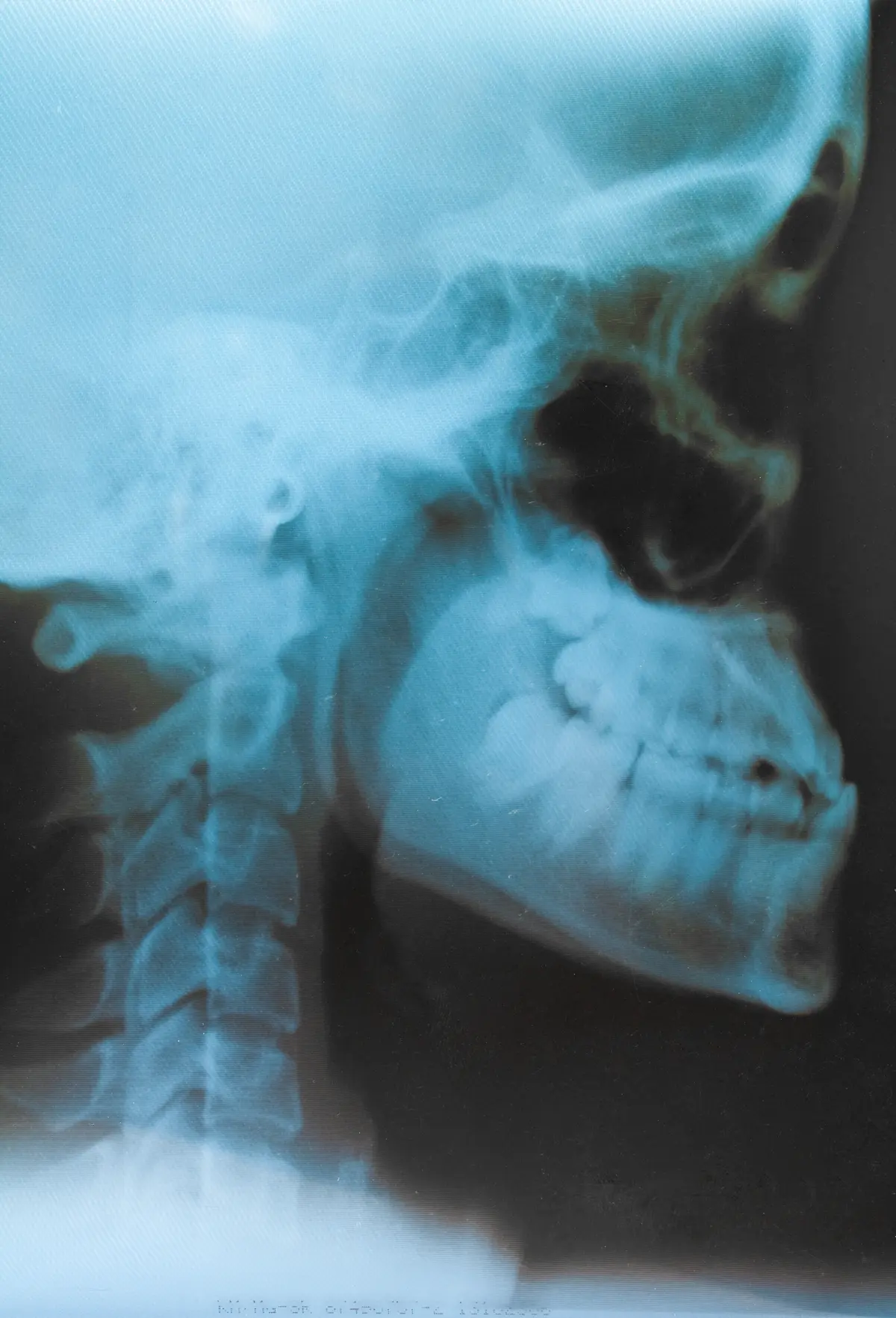 Una radiografía lateral de cráneo en el negatoscopio